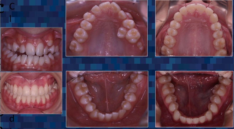 front, top, and bottom photos of teeth for maxillo-mandibular widening - Dr. Cesar Guerrero - Houston, TX